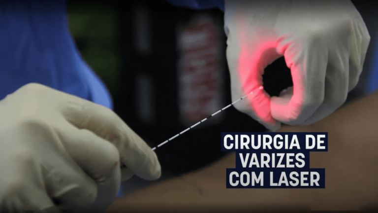 Cirurgia de Varizes com lazer