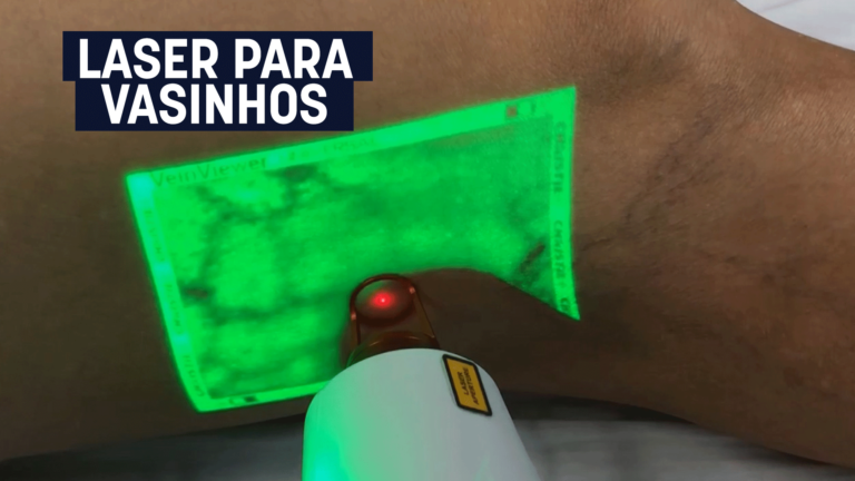 Laser para vasinhos