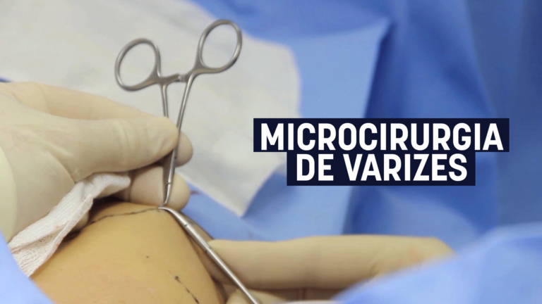 Microcirurgia de varizes